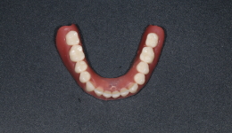 Metal Based Dentures